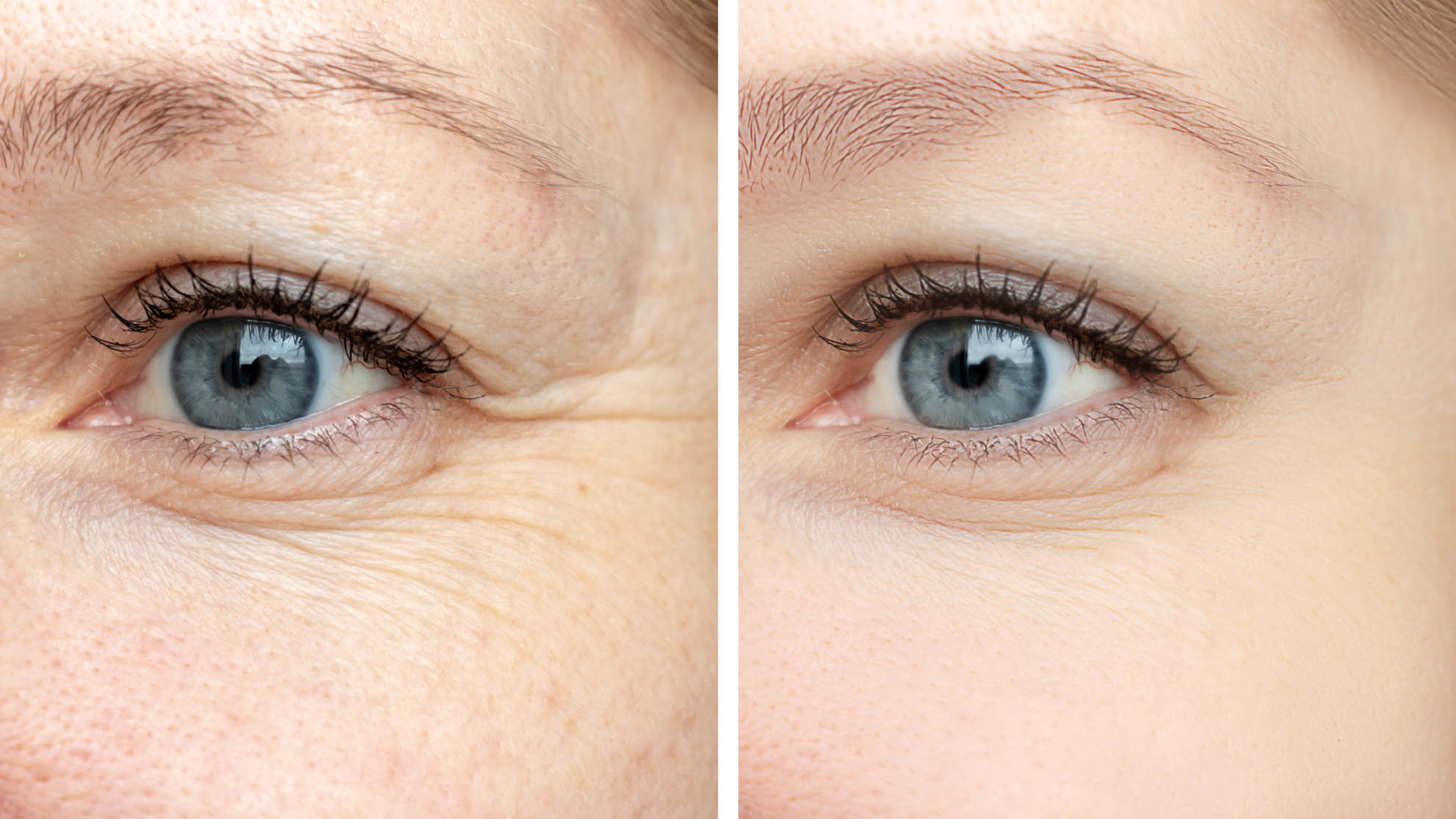 Woman face, eye wrinkles before and after treatment - the result of rejuvenating cosmetological procedures of biorevitalization, botox and pigment spots removal Woman face, eye wrinkles before and after treatment - the result of rejuvenating cosmetological procedures of biorevitalization, botox and pigment spots removal